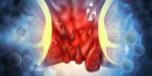 Fissure Treatment Services