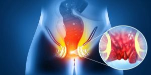Fistula Treatment Services
