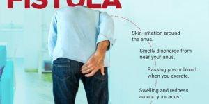 Fistula Treatment