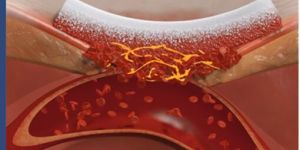 Hemostatic Gelatin Sponge