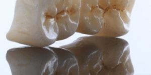 Zirconia Crowns and Bridges