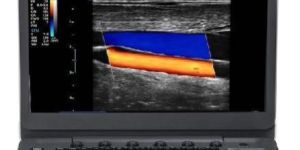 SonoScape E2 Color Doppler Ultrasound