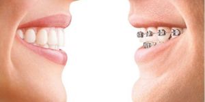 Dental Braces Treatment Services