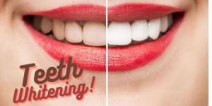 Tooth Whitening Services