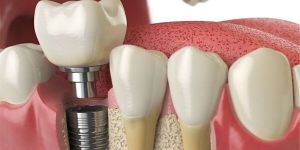 Root Canal Treatment