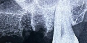 Invisalign Essentials Treatment Service