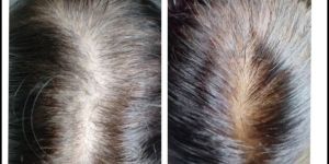 Hair Fall Treatment
