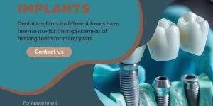 Dental Implants