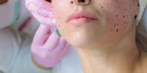 Acne Treatment Services