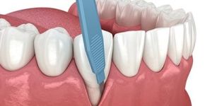 Composite Fillings