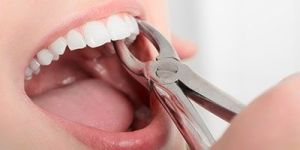 Dental Extraction