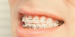 Metal & Ceramic Braces