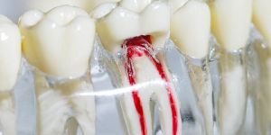 Root Canal Treatment