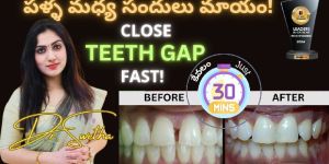 Teeth Gap Treatment