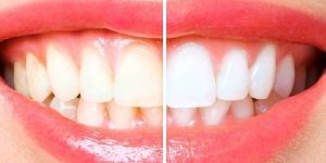 Teeth Whitening