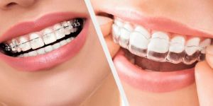BRACES ALIGNERS SERVICES
