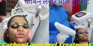 Carbon Laser Peel Treatment
