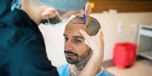 Hair Transplant in Delhi