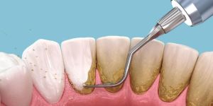 Teeth Cleaning Services