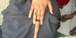SILICONE FINGER PROSTHESIS