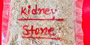 Kidney Stone Removal Jadibuti