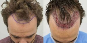 Permanent Hair Restoration