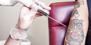 Laser Tattoo Removal Treatment