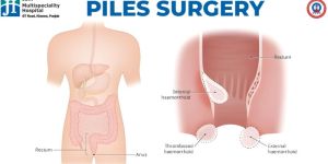 Piles Treatment