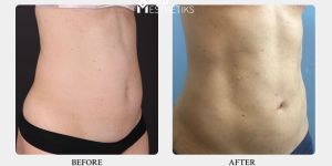 Liposuction Surgery in Delhi