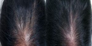 Hair Fall & Hair Regrowth Treatment