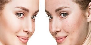 Laser Acne Scar Treatment