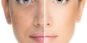 Laser Face Resurfacing