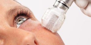 Mirapeel Facial Treatment