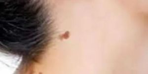 SKIN TAG REMOVAL TREATMENT