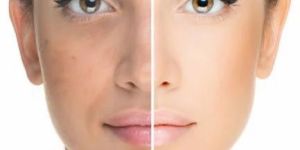 Skin Whitening Treatment Services