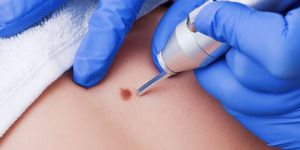 Wart Removal Treatment