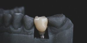 Dental Implant Surgery