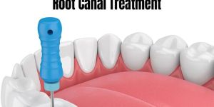 Root Canal Treatment