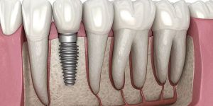 Dental Implants