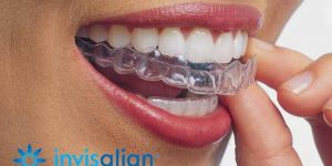 Invisalign Services