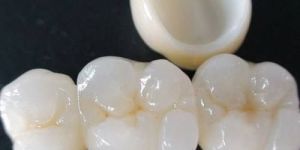 Zirconia Crowns