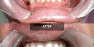 All in 6 Dental Implants