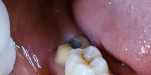 Dental Crowns
