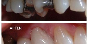 Dental Sealants
