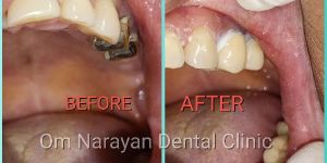 One Day Dental Implants