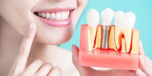 Dental Implants