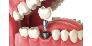 Dental Crowns & Bridges