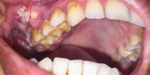 Laser Root Canal Treatment