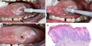 Occlusal Splint Therapy