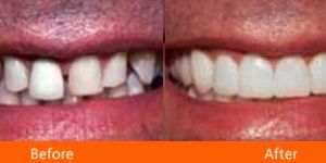 Digital Smile Designing Service